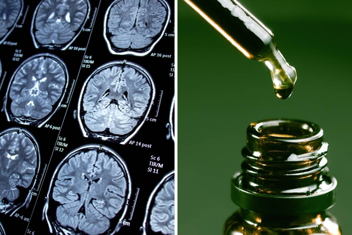 CBD Products for Treating Seizures